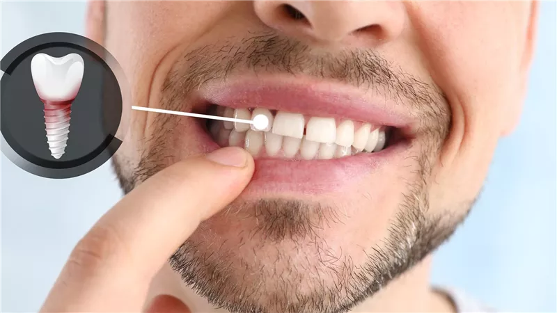 متى نحتاج زراعة الأسنان؟.. تناول طعامك دون قلق