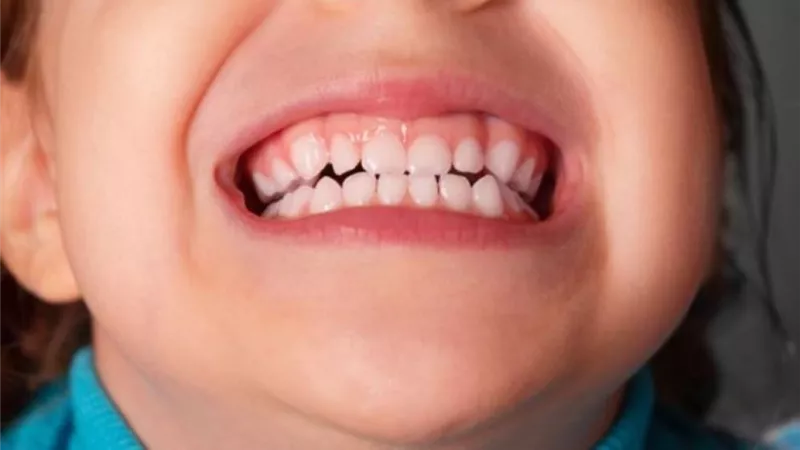 كيفية التخلص من كز الأسنان أثناء النوم