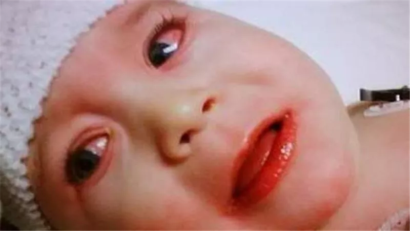 مرض كاواساكي للأطفال.. عدوى فيروسية خطيرة تصيب الصغار بهذه الأعراض