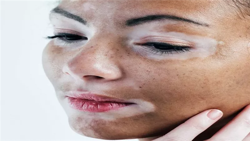 في المنزل.. أسرع طريقة لعلاج البهاق دون تعب