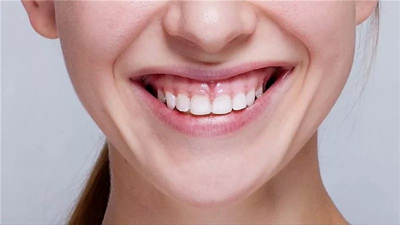 ما هي الابتسامة اللثوية؟.. علاجها طبيعيًا أمر ممكن