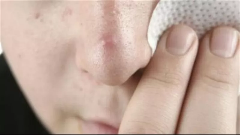 كيف أتخلص من البثور السوداء في الأنف؟.. حلول منزلية بمعجون الأسنان والفازلين 