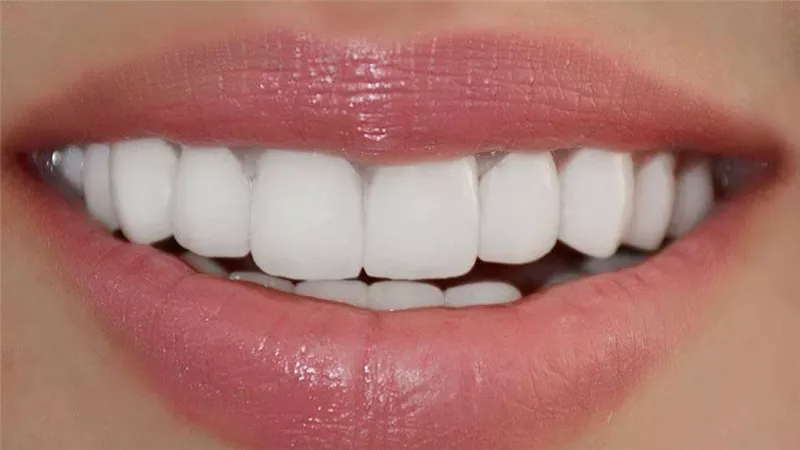 ما هي ابتسامة هوليود؟.. تجميل الأسنان وتبييضها في نفس الوقت