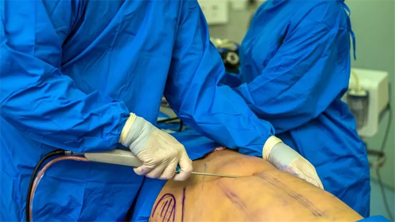 الدومينيكان.. مقبرة الأمريكان خلال عمليات التجميل وشفط الدهون