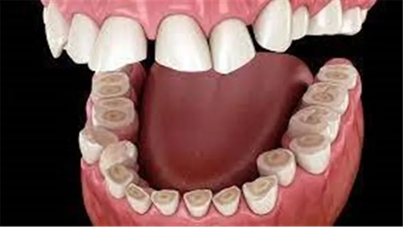 أسباب كز الأسنان.. التّوتر والضّغط النفسي أهمها