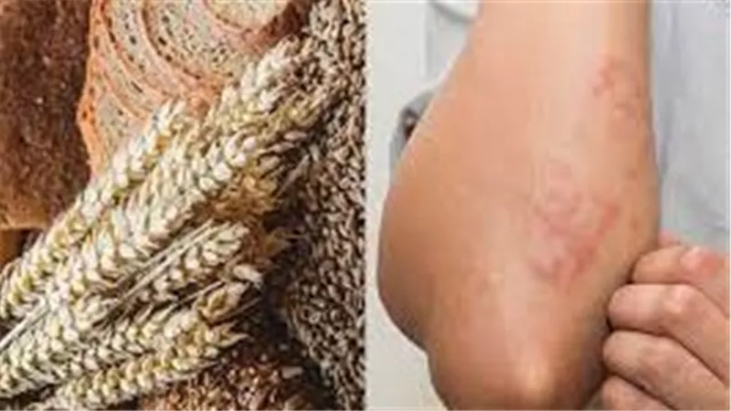 ما هى حساسية الجلوتين؟.. تعرف على أعراضها