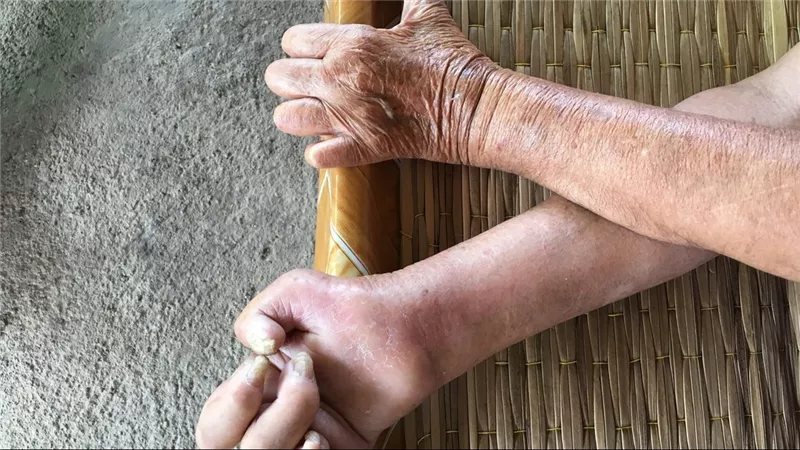 أسباب مرض الجذام وأعراضه وعلاجاته.. احذر مضاعفاته 