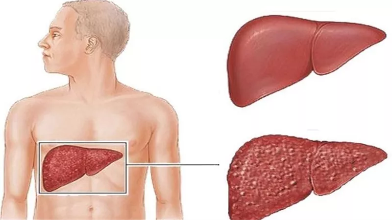 أسباب التهاب الكبد الوبائي وطرق انتشار العدوى الفيروسية