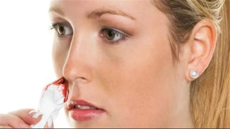 أسباب نزيف الأنف و6 خطوات للسيطرة عليه