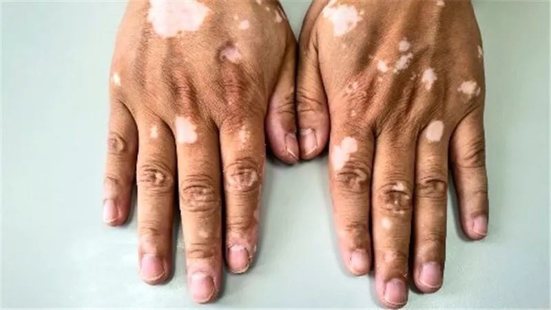 سبب البهاق وأنواعه وأعراضه وعلاجاته.. مرض جلدي غير معدي