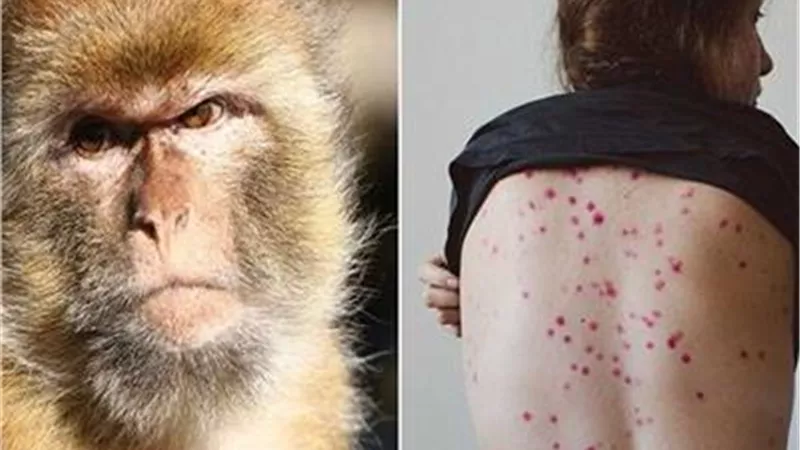 تسجيل أول حالة وفاة بسلالة 1 من جدري القرود في كندا 
