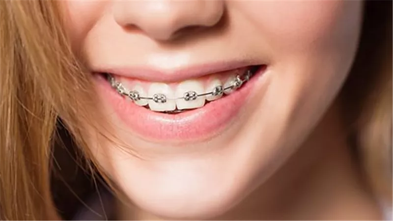 8 أسئلة تخص تقويم الأسنان.. تعرف على إجابتها قبل الذهاب إلى الطبيب