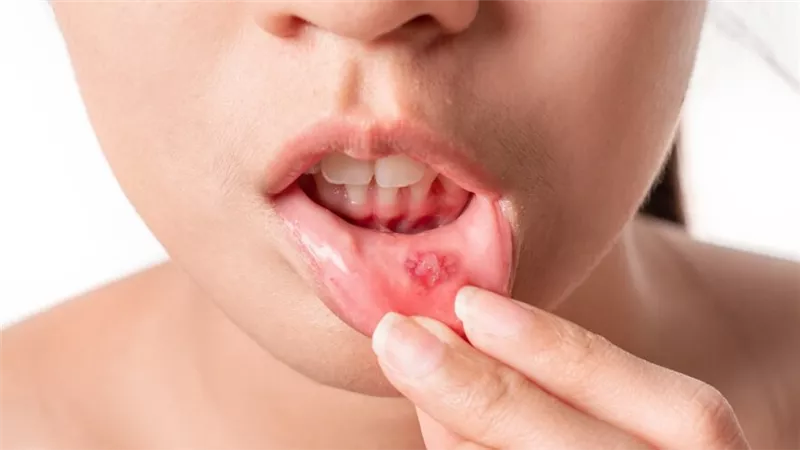 كيفية التخلص من تقرحات الفم بـ 7 طرق طبيعية في المنزل 