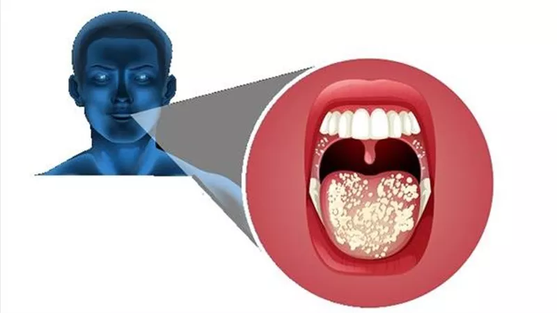 علاج التهاب اللسان في المنزل.. تخلص منه نهائيا بهذه الطرق