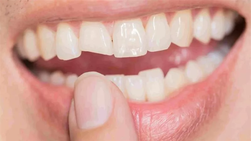 إصلاح الأسنان المكسورة.. 5 خطوات لترميمها من جديد