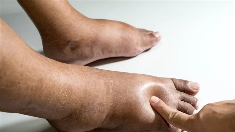 أسباب احتباس السوائل في الجسم.. 10 عوامل محفزة بعضها خطير جدًا
