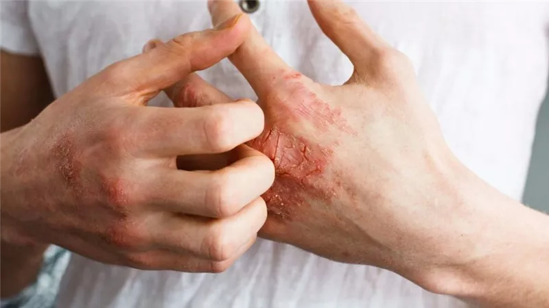 5 مشاكل جلدية مرتبطة بمرض السكري.. احذرها