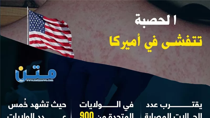 الحصبة تتفشى في أميركا (فيديوجراف)