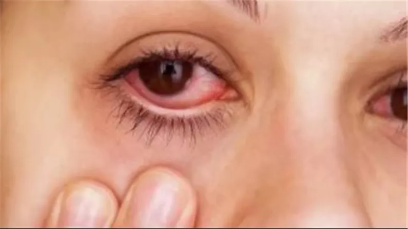 نصائح ذهبية لمرضى حساسية العين