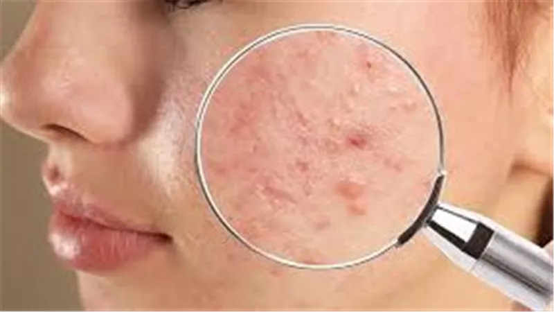 طرق التخلص من حبوب الوجه بسرعة.. 8 خطوات فعالة