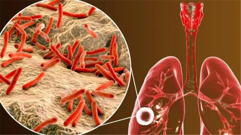 دليل شامل لمرض السل.. الأسباب والأعراض والعلاج