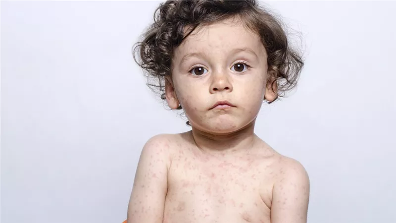 أسباب وأعراض الحصبة الألمانية.. طرق العلاج والوقاية