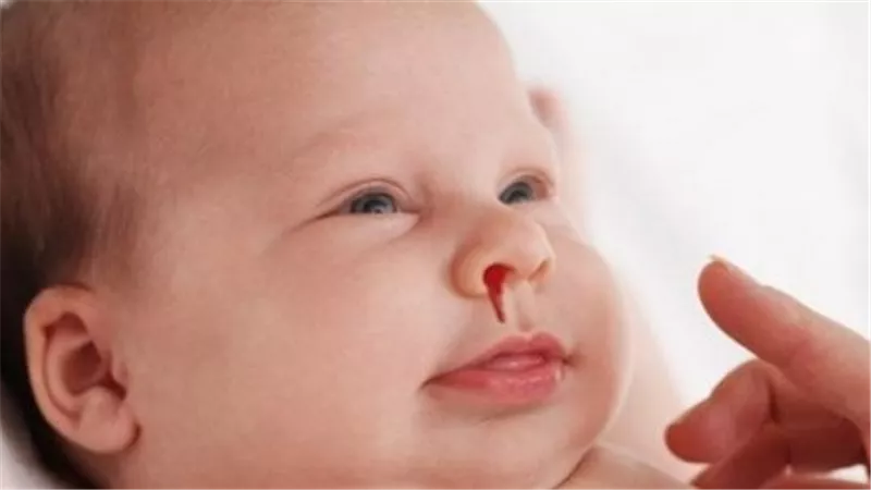 أسباب نزيف الأنف عند الأطفال.. عوامل شائعة وأخرى نادرة
