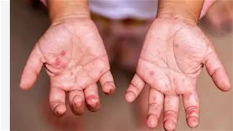  فيروس HFMD: الأعراض، الأسباب، وطرق العلاج