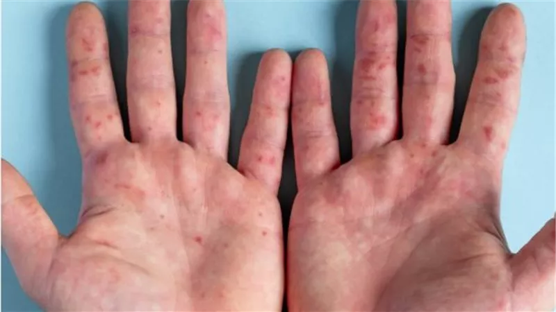 فيروس HFMD: كل ما تحتاج معرفته عن المرض المنتشر بين الأطفال