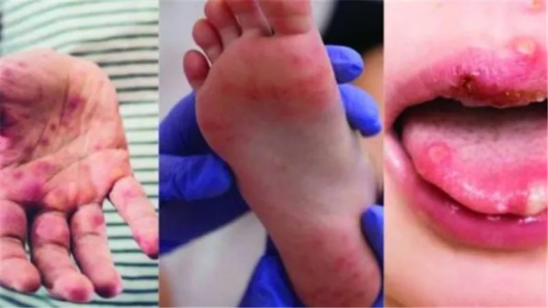 أعراض فيروس hfmd اليد والقدم والفم وطرق الوقاية منه