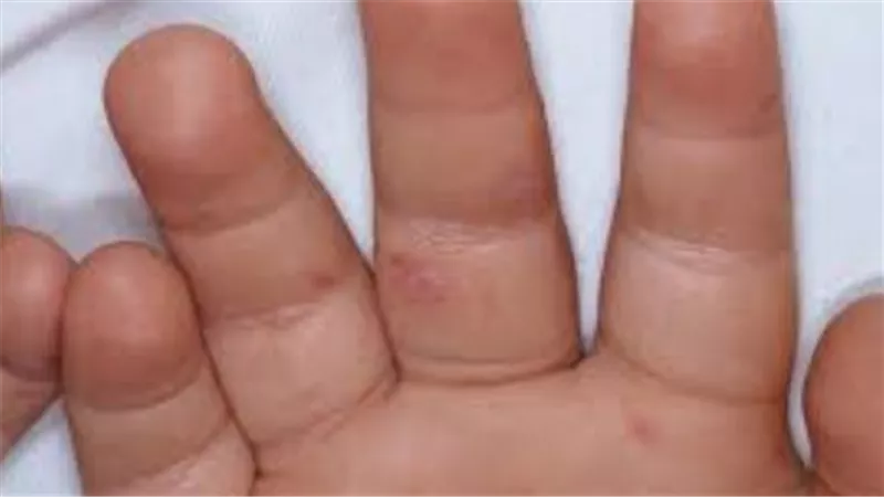 أسباب فيروس HFMD وكيفية انتقال العدوى بين الأطفال