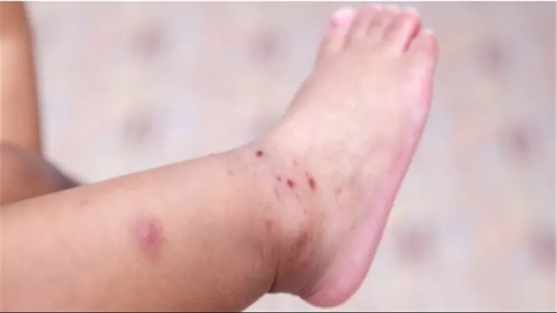 فيروس HFMD: متى يصبح من الضروري مراجعة الطبيب فورًا؟
