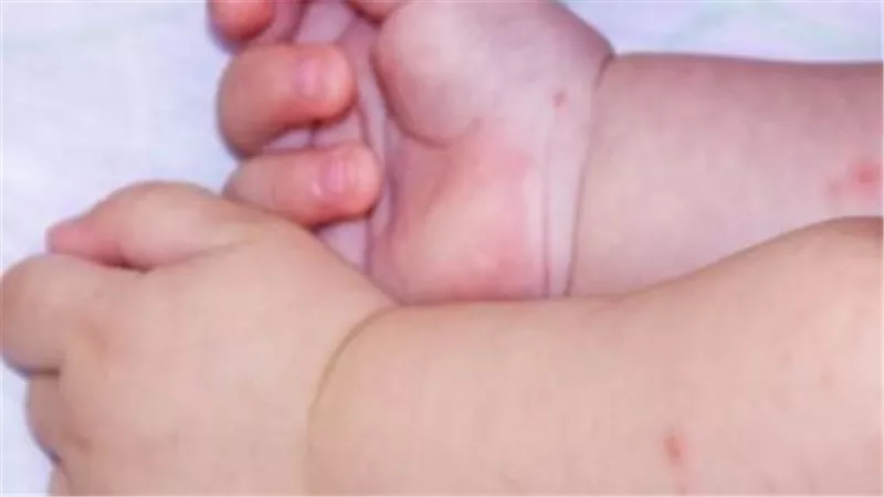 فيروس hfmd حقيقة مرض اليد والقدم والفم: مرض بسيط أم خطر على الأطفال؟