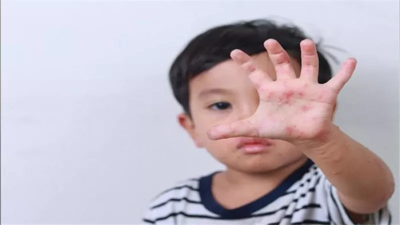 الوقاية من فيروس HFMD: خطوات عملية لحماية طفلك