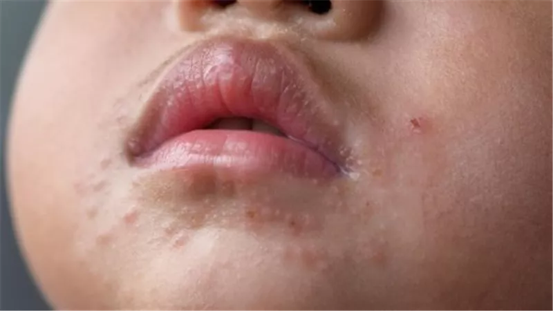 HFMD: مرض فيروسي سريع الانتشار يهدد المدارس والحضانات