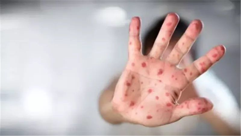 وزارة الصحة تكشف حقيقة إغلاق مدرسة دولية بالجيزة بسبب فيروس hfmd