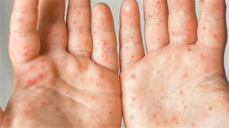 أسباب الإصابة بفيروس HFMD.. وطرق العلاج وأعراضه