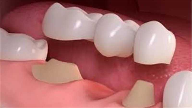 ما هي خطوات تركيب الأسنان؟ 