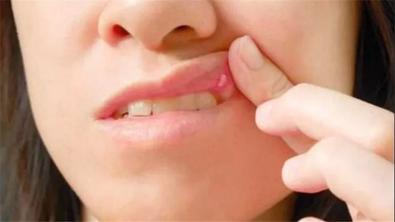 دليل التعافي السريع.. كيف تعالج التهابات الفم والقروح بفعالية وأمان؟