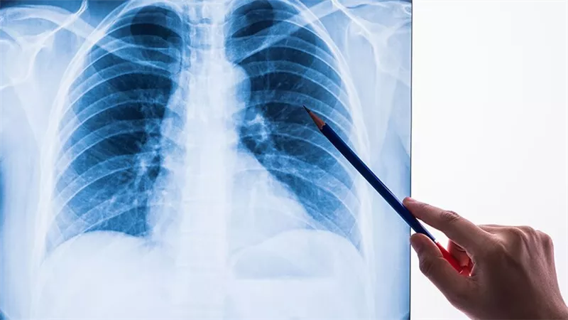 باحثون: داء السل أخطر من كورونا 