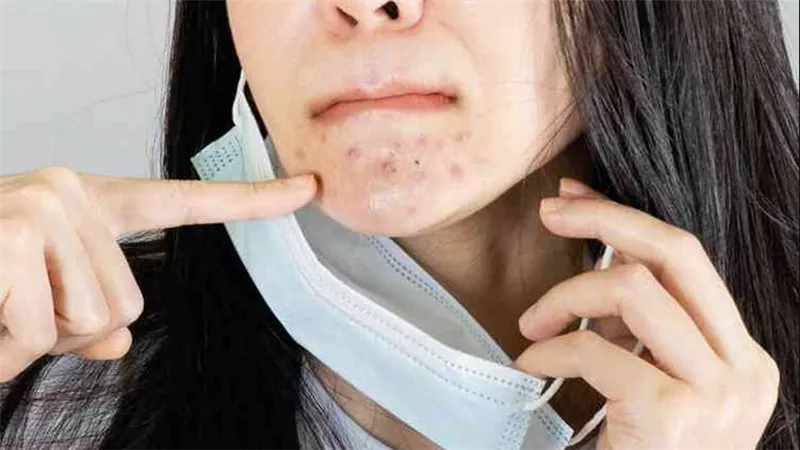 ما هو حل وعلاج البثور الناتجة عن ارتداء الكمامة؟