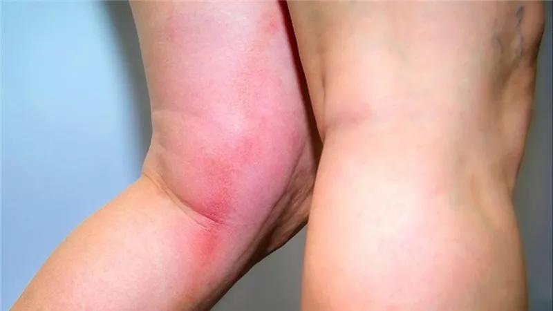 تعرف على أعراض تجلط الدم في الرجل