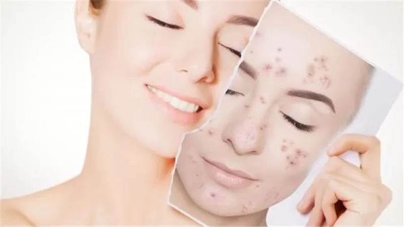 موجودة بالفعل في المنزل... منتجات منزلية طبيعية يمكن استخدامها لعلاج حب الشباب!