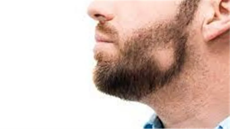 دواء شائع لالتهاب المفاصل.. ما علاقته بعلاج الثعلبة؟