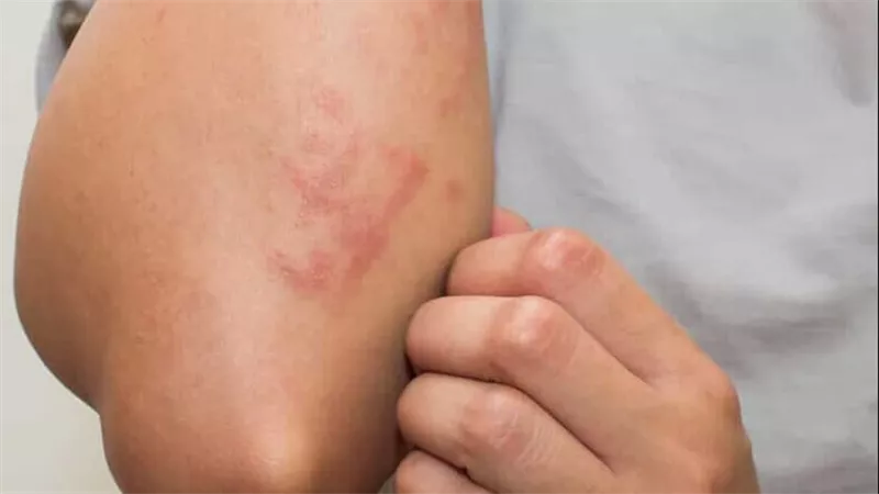 كيف تتسبب بعض الأدوية في جعل الجلد حساسا للضوء؟