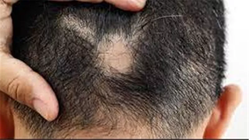 متى يبدأ داء الثعلبة عادة؟