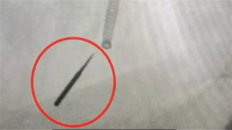 واقعة نادرة.. مريض يبتلع عن طريق الخطأ مثقاب أسنان