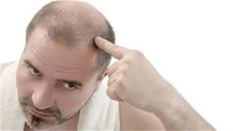 السبب الأكثر شيوعا لتساقط الشعر عند الرجال 