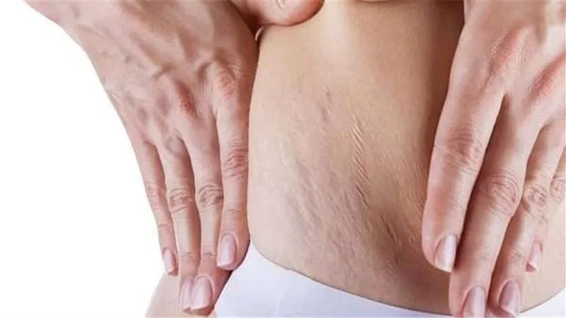  السيلوليت ظاهرة شائعة.. فكيف نتخلص منها؟