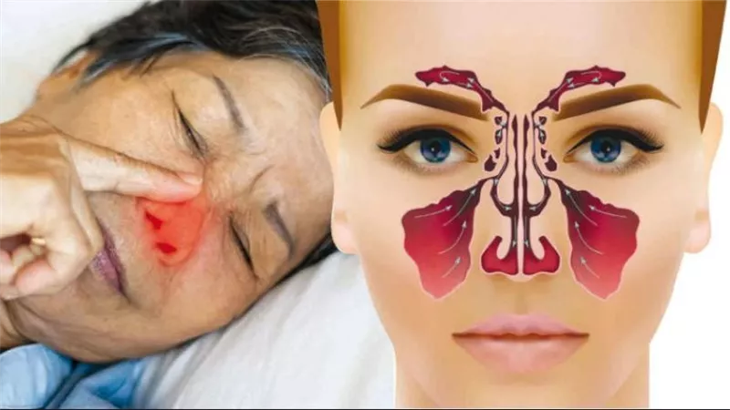 أعراض الجيوب الأنفية وعلاجها.. تجنب المسببات أبرز الطرق 